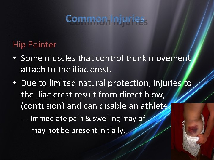 Hip Pointer • Some muscles that control trunk movement attach to the iliac crest.