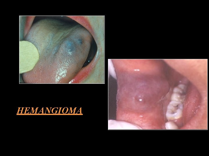 HEMANGIOMA 