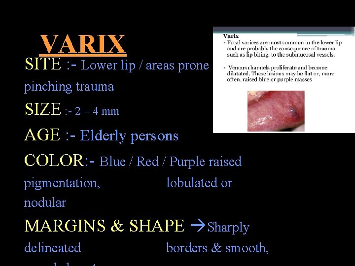 VARIX SITE : - Lower lip / areas prone to pinching trauma SIZE :