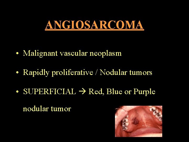 ANGIOSARCOMA • Malignant vascular neoplasm • Rapidly proliferative / Nodular tumors • SUPERFICIAL Red,