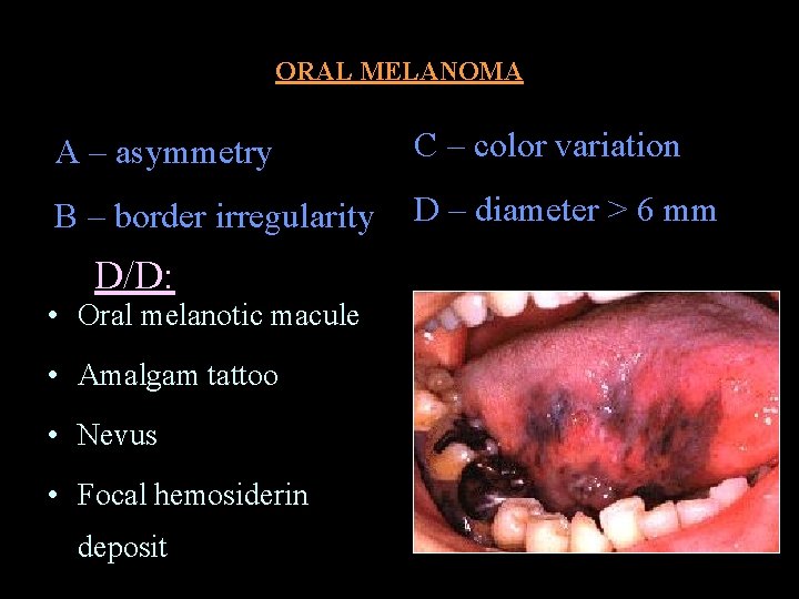 ORAL MELANOMA A – asymmetry C – color variation B – border irregularity D