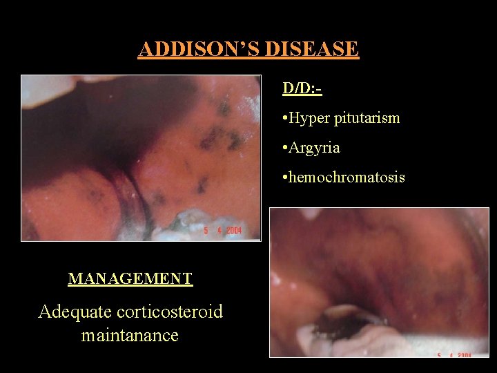 ADDISON’S DISEASE D/D: - • Hyper pitutarism • Argyria • hemochromatosis MANAGEMENT Adequate corticosteroid