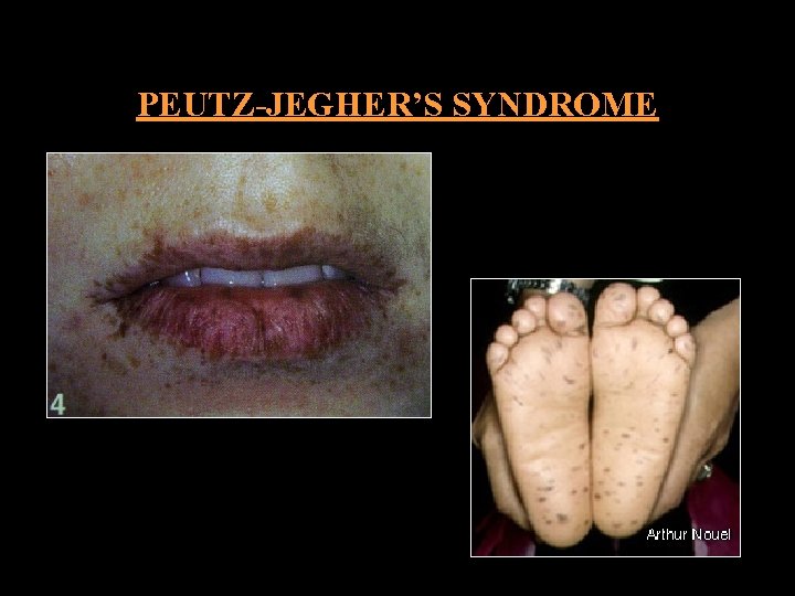 PEUTZ-JEGHER’S SYNDROME 