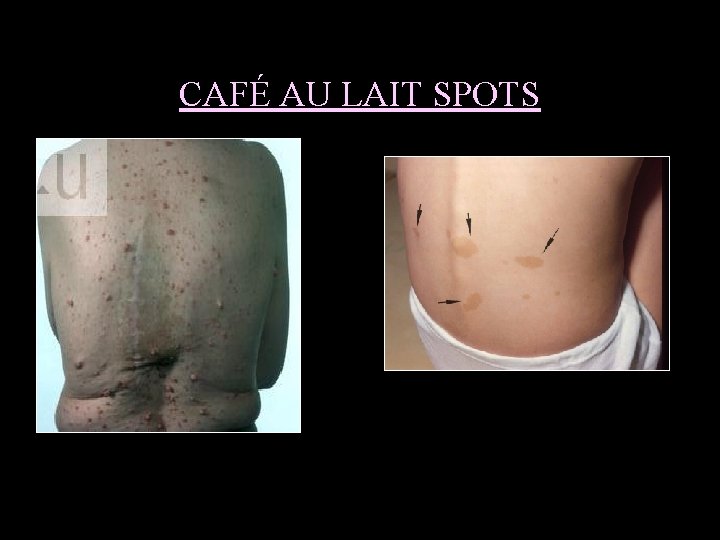 CAFÉ AU LAIT SPOTS 