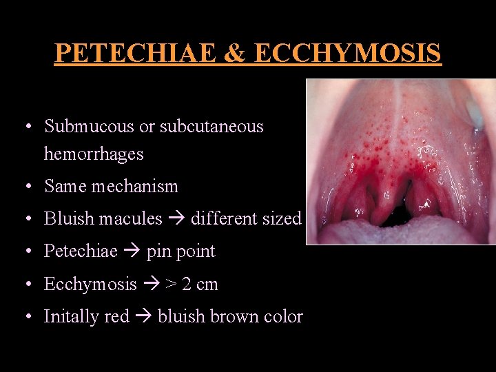 PETECHIAE & ECCHYMOSIS • Submucous or subcutaneous hemorrhages • Same mechanism • Bluish macules