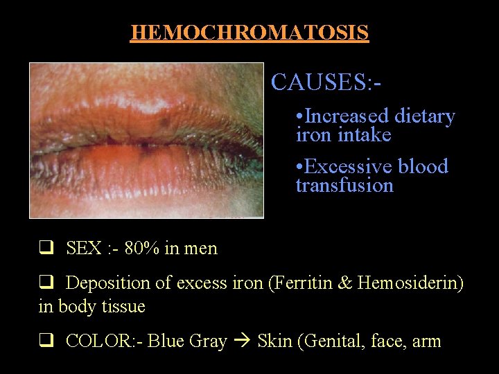 HEMOCHROMATOSIS CAUSES: • Increased dietary iron intake • Excessive blood transfusion q SEX :