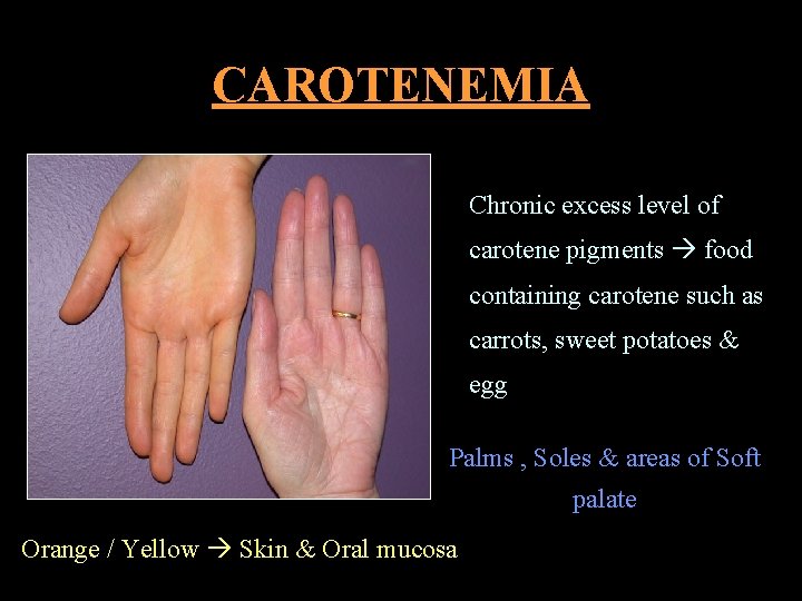 CAROTENEMIA Chronic excess level of carotene pigments food containing carotene such as carrots, sweet