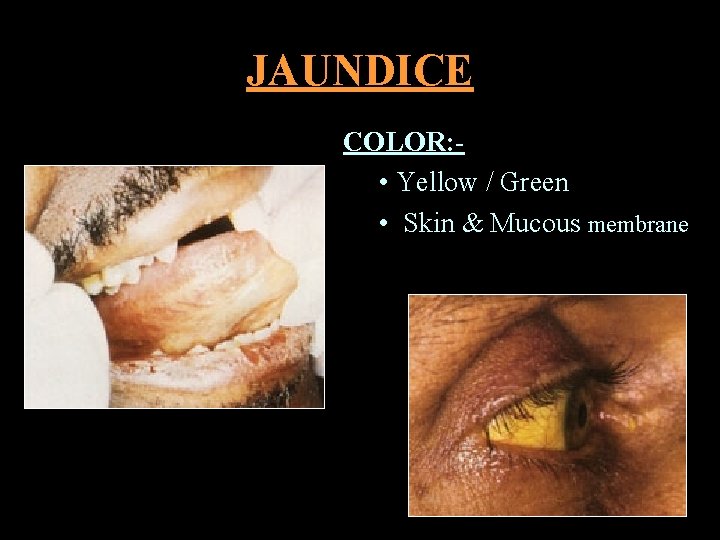 JAUNDICE COLOR: • Yellow / Green • Skin & Mucous membrane 