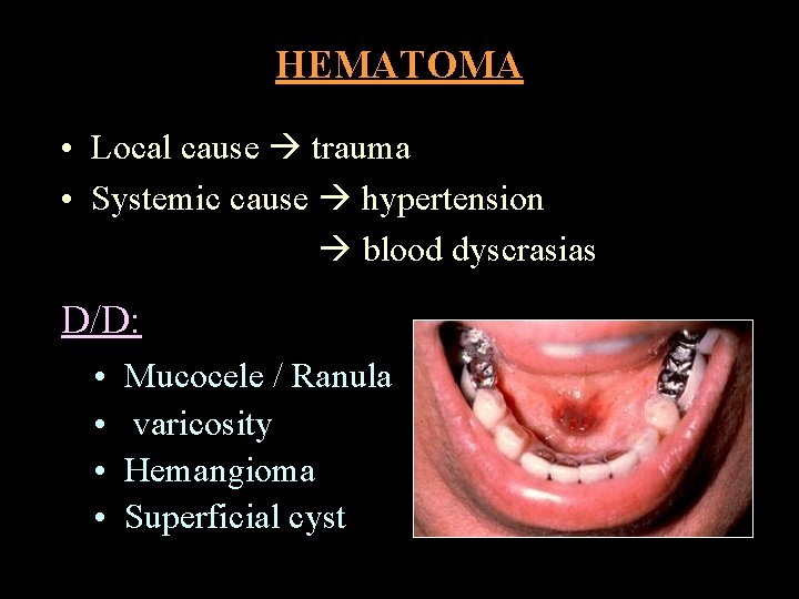 HEMATOMA • Local cause trauma • Systemic cause hypertension blood dyscrasias D/D: • •