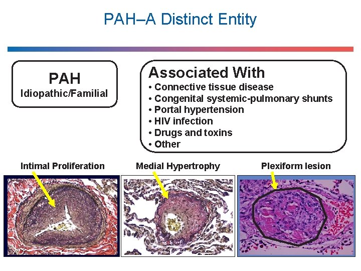 PAH–A Distinct Entity PAH Idiopathic/Familial Intimal Proliferation Associated With • Connective tissue disease •