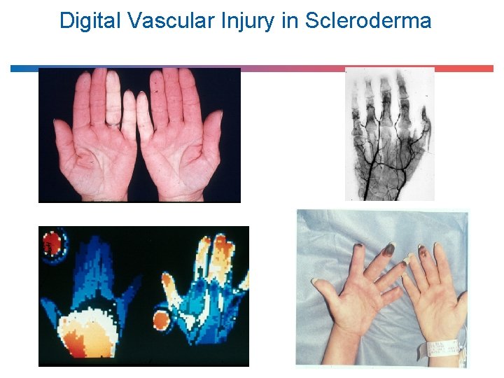Digital Vascular Injury in Scleroderma 