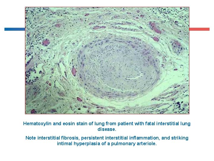 Hematoxylin and eosin stain of lung from patient with fatal interstitial lung disease. Note