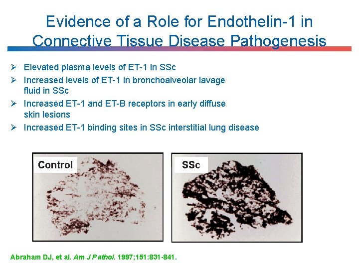 Evidence of a Role for Endothelin-1 in Connective Tissue Disease Pathogenesis Ø Elevated plasma