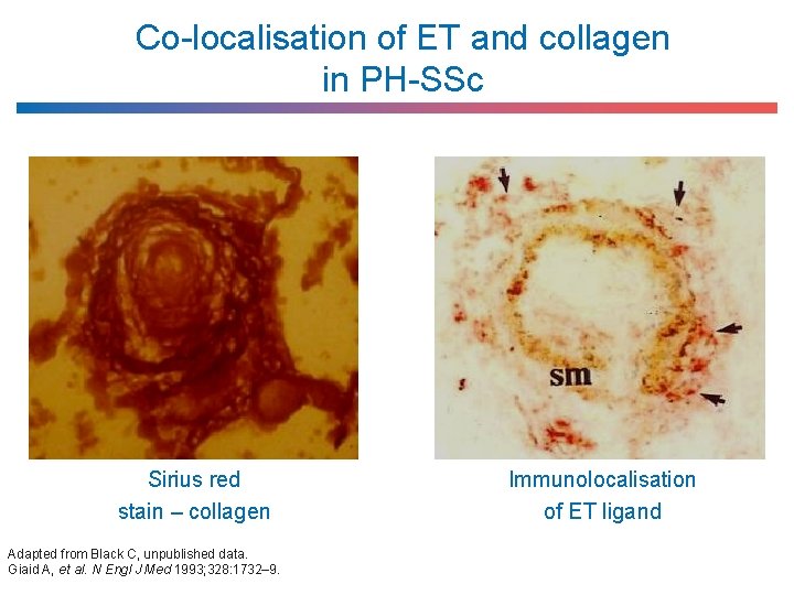 Co-localisation of ET and collagen in PH-SSc Sirius red stain – collagen Adapted from