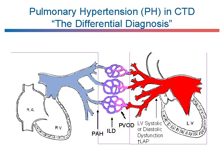 Pulmonary Hypertension (PH) in CTD “The Differential Diagnosis” PAH ILD PVOD LV Systolic or