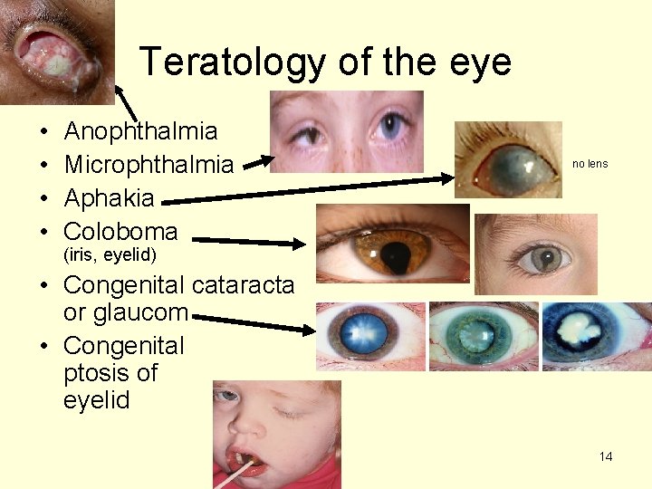 Teratology of the eye • • Anophthalmia Microphthalmia Aphakia Coloboma no lens (iris, eyelid)