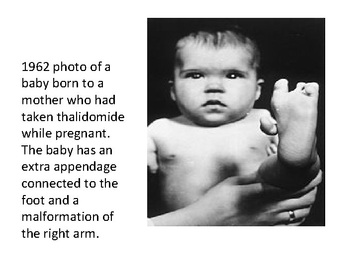 1962 photo of a baby born to a mother who had taken thalidomide while