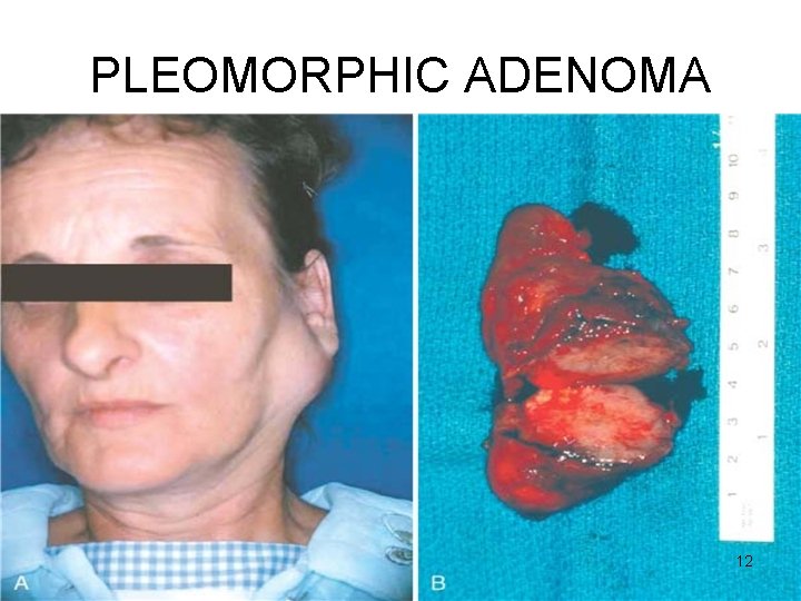 PLEOMORPHIC ADENOMA 12 