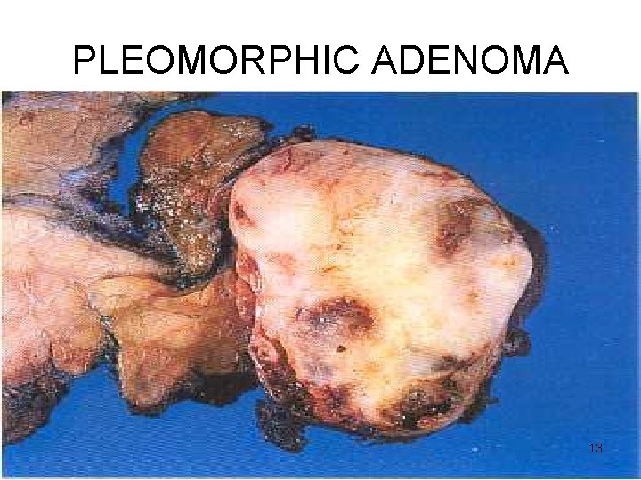 PLEOMORPHIC ADENOMA 13 