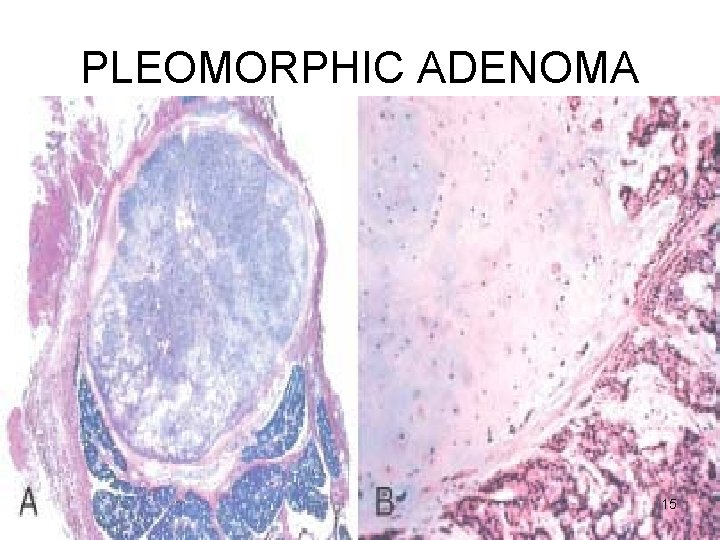 PLEOMORPHIC ADENOMA 15 