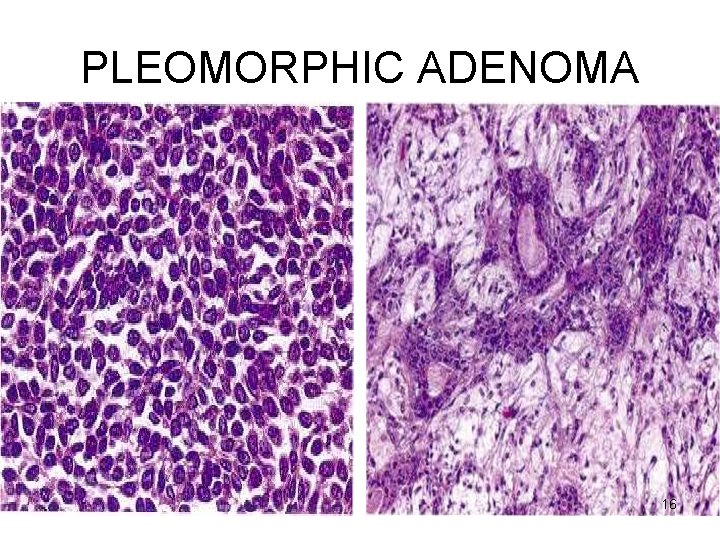 PLEOMORPHIC ADENOMA 16 