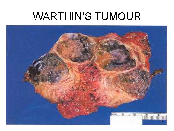 WARTHIN’S TUMOUR 21 