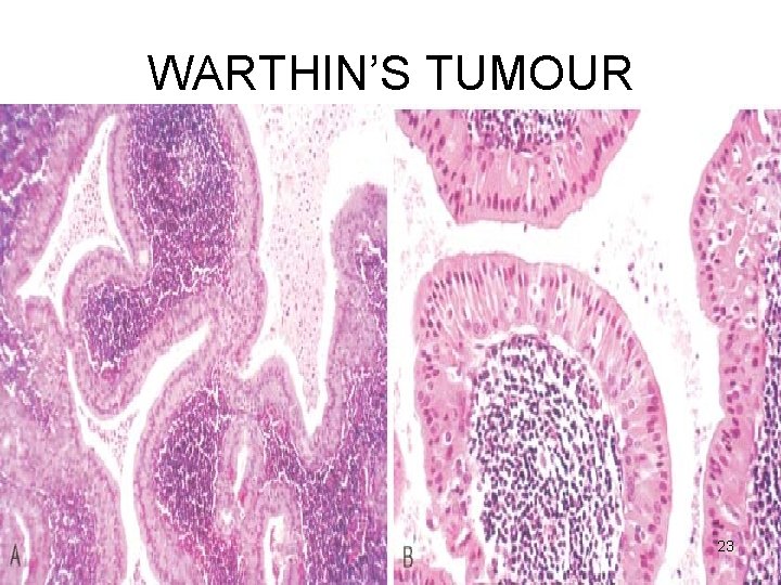 WARTHIN’S TUMOUR 23 