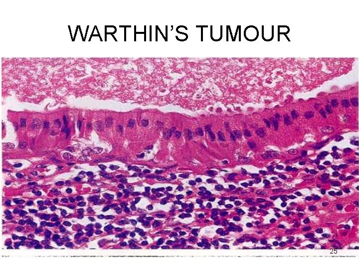 WARTHIN’S TUMOUR 25 