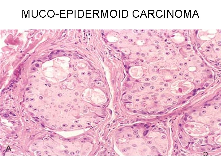 MUCO-EPIDERMOID CARCINOMA 33 