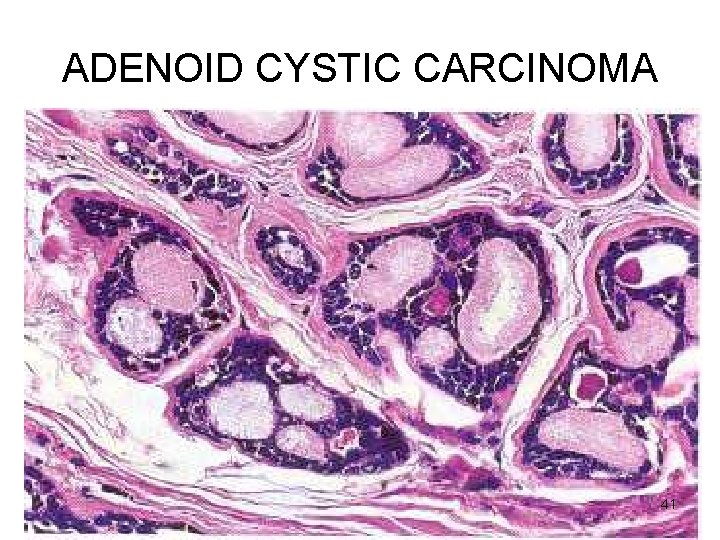 ADENOID CYSTIC CARCINOMA 41 