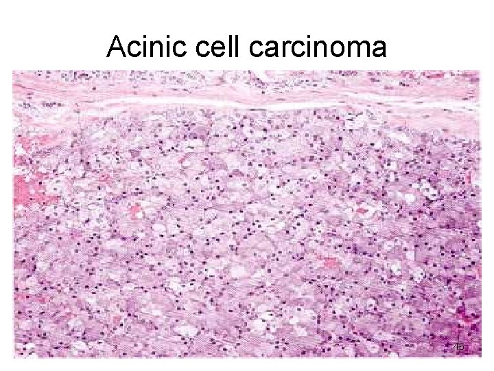 Acinic cell carcinoma 46 