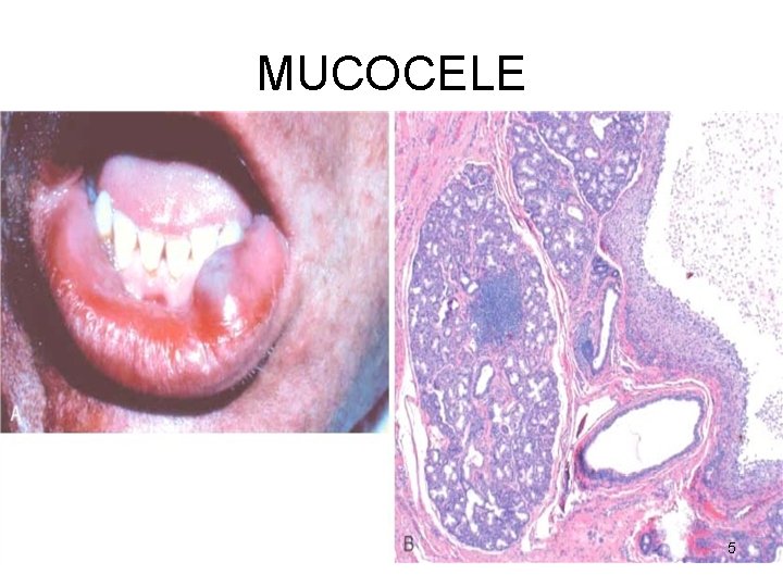 MUCOCELE 5 