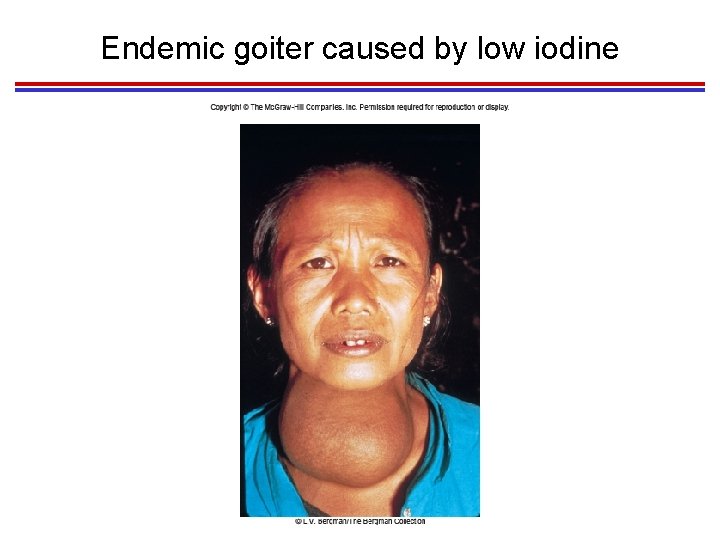 Endemic goiter caused by low iodine 