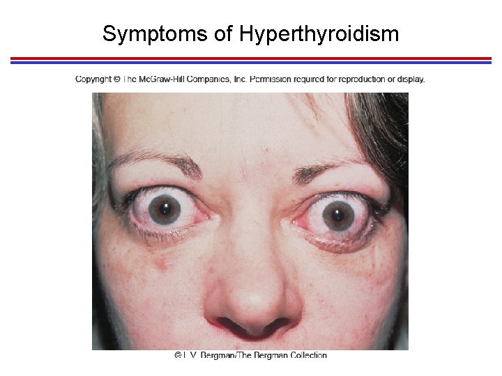 Symptoms of Hyperthyroidism 