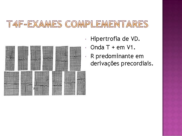  Hipertrofia de VD. Onda T + em V 1. R predominante em derivações