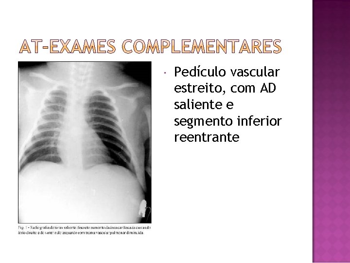  Pedículo vascular estreito, com AD saliente e segmento inferior reentrante 