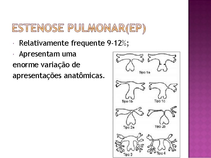 Relativamente frequente 9 -12%; Apresentam uma enorme variação de apresentações anatômicas. 