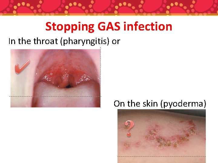 Stopping GAS infection In the throat (pharyngitis) or On the skin (pyoderma) 