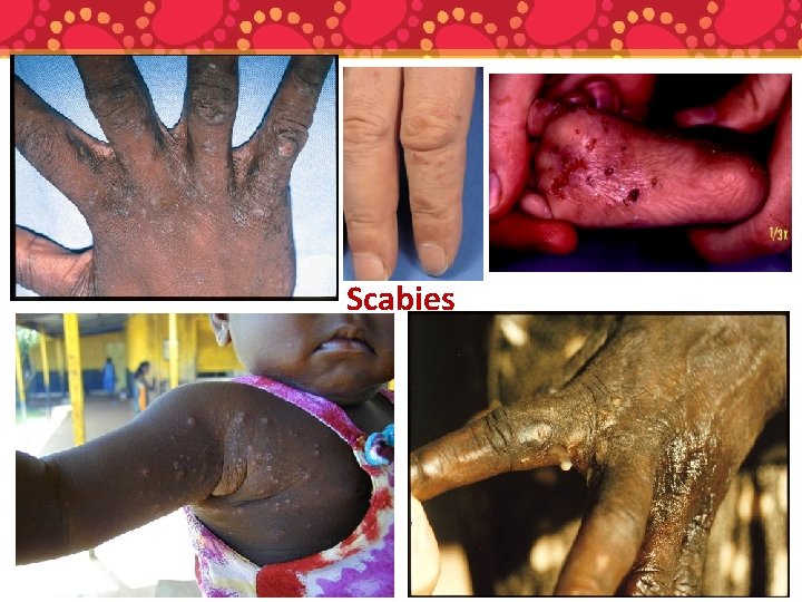 Scabies 