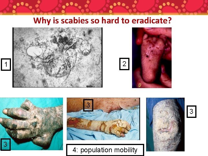 Why is scabies so hard to eradicate? 2 1 3 3 4: population mobility