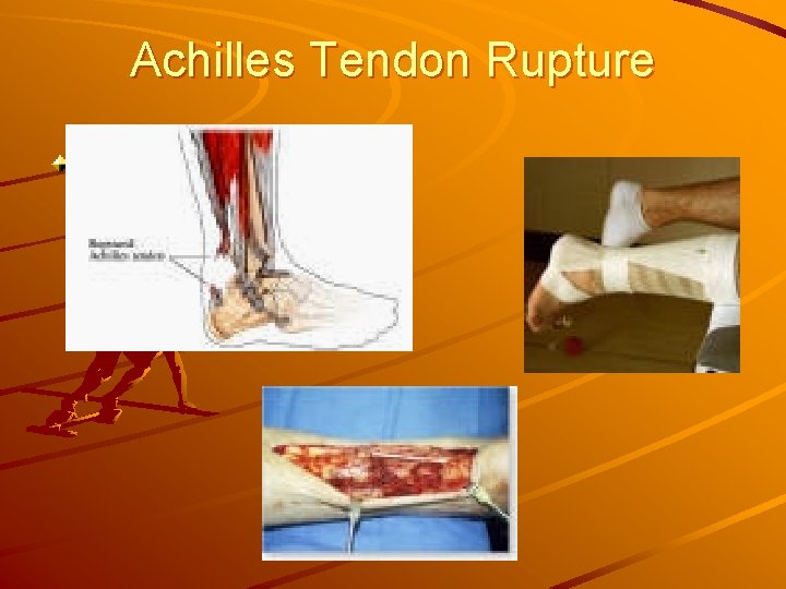 Achilles Tendon Rupture 