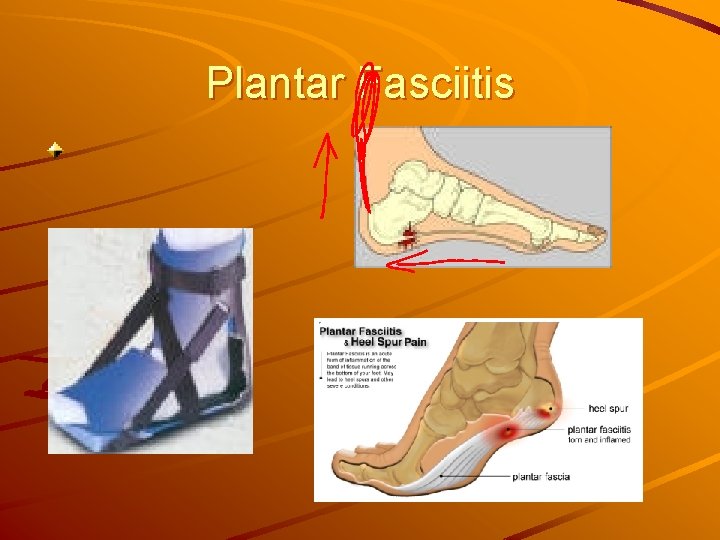 Plantar Fasciitis 
