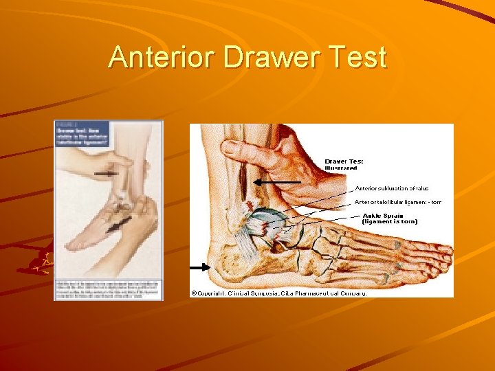 Anterior Drawer Test 