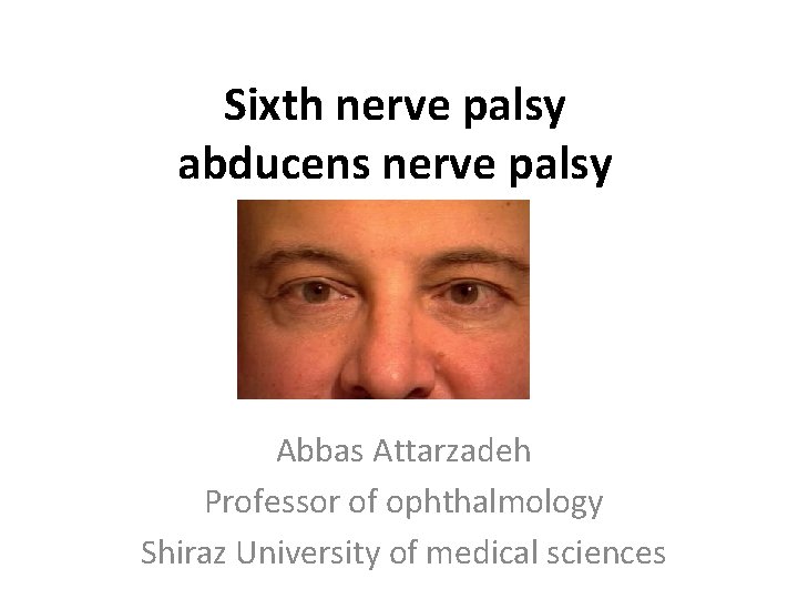 Sixth nerve palsy abducens nerve palsy Abbas Attarzadeh Professor of ophthalmology Shiraz University of