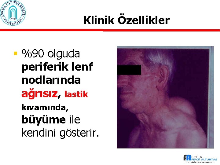 Klinik Özellikler § %90 olguda periferik lenf nodlarında ağrısız, lastik kıvamında, büyüme ile kendini