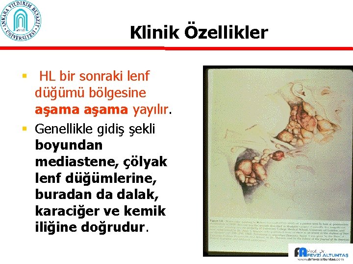 Klinik Özellikler § HL bir sonraki lenf düğümü bölgesine aşama yayılır. § Genellikle gidiş