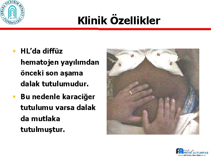 Klinik Özellikler § HL’da diffüz hematojen yayılımdan önceki son aşama dalak tutulumudur. § Bu