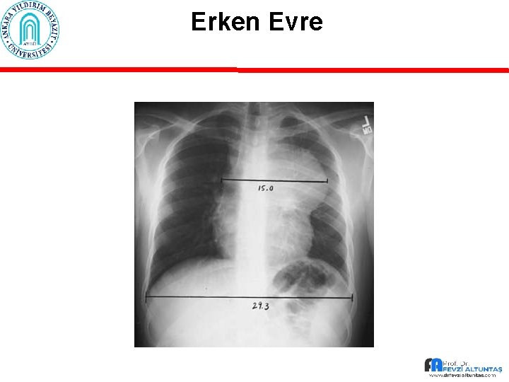 Erken Evre 