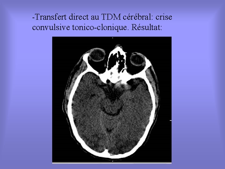 -Transfert direct au TDM cérébral: crise convulsive tonico-clonique. Résultat: 