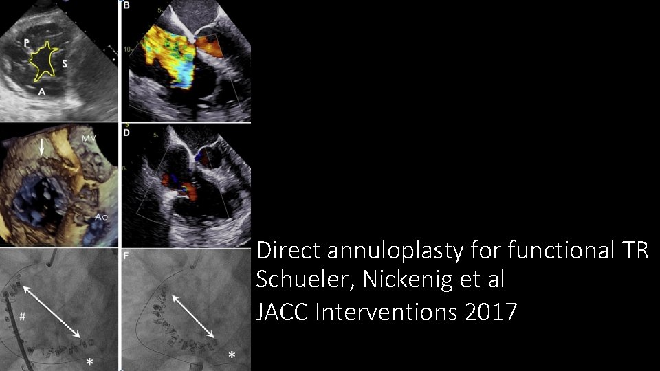 Direct annuloplasty for functional TR Schueler, Nickenig et al JACC Interventions 2017 